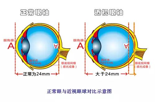 “再等等”已经成为青少年高度近视的助推器！